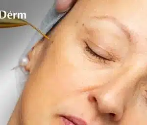 Bio Plasma Lift