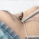 Curso de Bio Filler Fiber Hilos 4 mini hilos