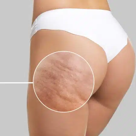Inicio 15 Tratamiento celulitis