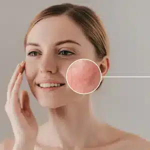 Taller de Rosácea